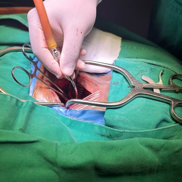 Discitis Cervical Con Absceso - Descompresion Cervical Con Artrodesis - Dr. David Tafur