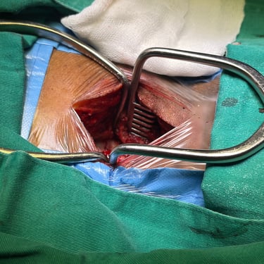 Discitis Cervical Con Absceso - Descompresion Cervical Con Artrodesis - Dr. David Tafur