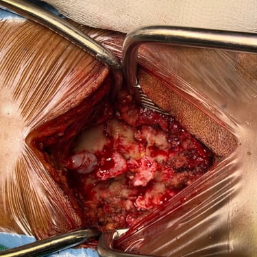 Discitis Cervical Con Absceso - Descompresion Cervical Con Artrodesis - Dr. David Tafur