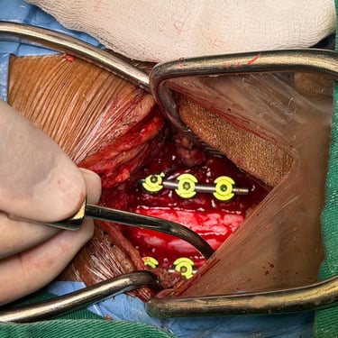 Discitis Cervical Con Absceso - Descompresion Cervical Con Artrodesis - Dr. David Tafur