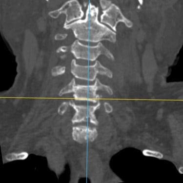 Discitis Cervical Con Absceso - Descompresion Cervical Con Artrodesis - Dr. David Tafur