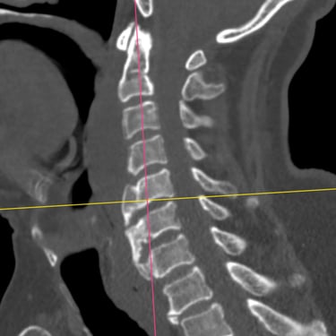 Discitis Cervical Con Absceso - Descompresion Cervical Con Artrodesis - Dr. David Tafur