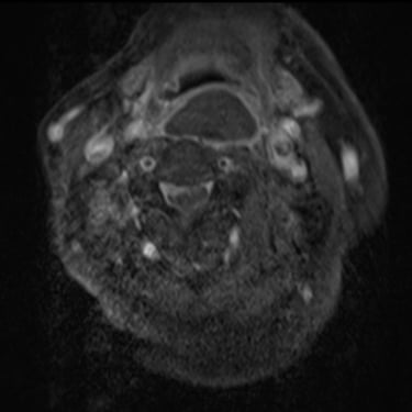 Discitis Cervical Con Absceso - Descompresion Cervical Con Artrodesis - Dr. David Tafur