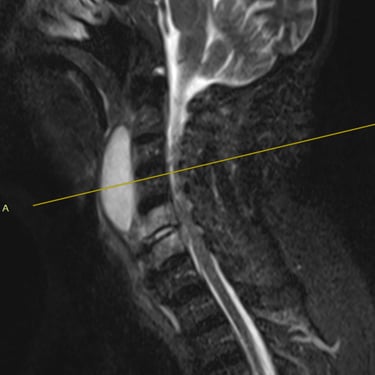 Discitis Cervical Con Absceso - Descompresion Cervical Con Artrodesis - Dr. David Tafur