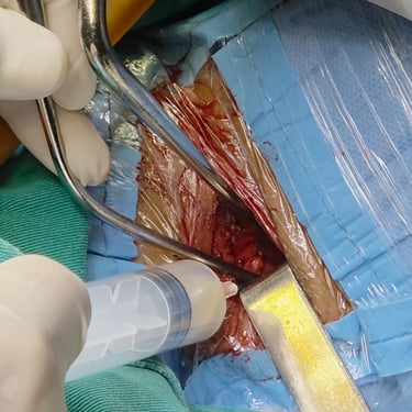 Discitis Cervical Con Absceso - Descompresion Cervical Con Artrodesis - Dr. David Tafur