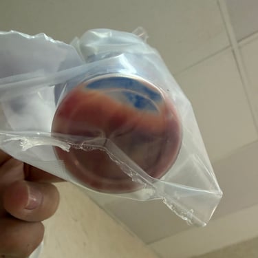 Discitis Cervical Con Absceso - Descompresion Cervical Con Artrodesis - Dr. David Tafur