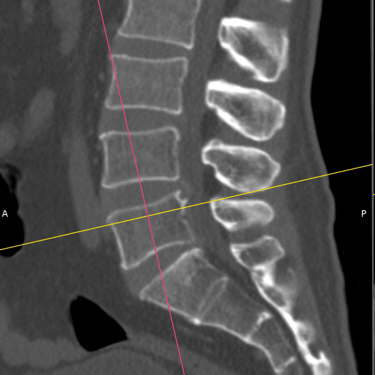 Discopatia lumbar - hernias - inestabilidad de columna - dr david tafur - neurocirujano de columna (1)