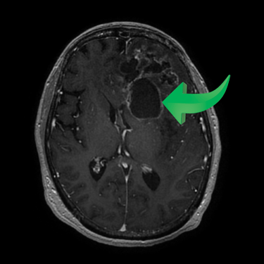 tumor cerebral, dr tafur, mejor neurocirujano, microcirugia cerebral