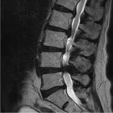 Listesis l4l5 con Estenosis severa - Fijacion transpedicular y TLIF - Dr. David Tafur (2)