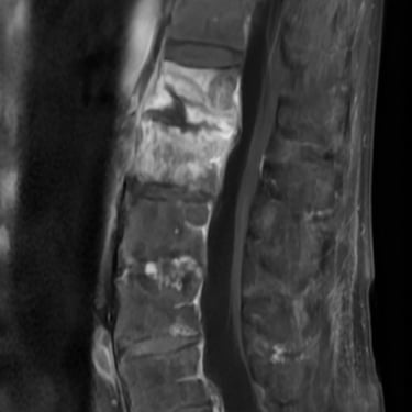 Espondilodiscitis - discitis - biopsia de disco -cirugia de columna vertebral- dr tafur -neuro-neurocirugia- mejor neurociru
