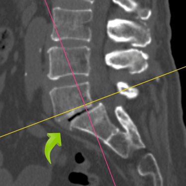 Espondilolistesi lumbar, listesis anterior, dr tafur, artrodesis lumbar