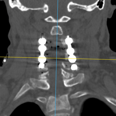 Estenosis cervical - espondiloartrosis cervical - dr . david tafur - neurocirujano en lima (2)