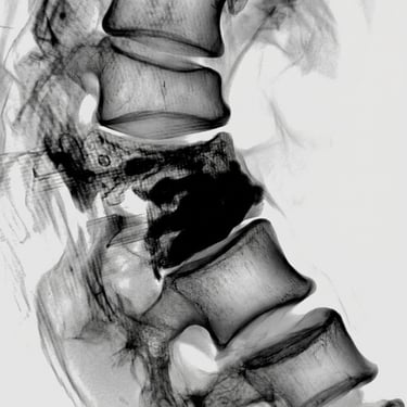 Fractura Dorsal por Osteoporosis: Vertebroplastia Percutánea Bilateral