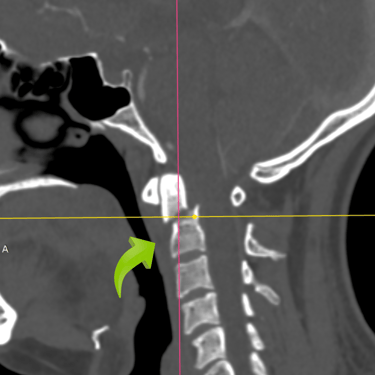 Fractura odontoidea, fractura vertebral, cirugia vertebral, dr tafur, mejor neurocirujano