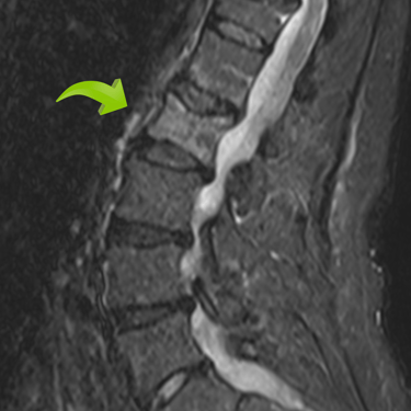 Fractura por osteoporsis, cirugia de columna vertebral, dr tafur, mejor neurocirujano
