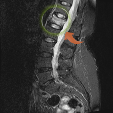 Fractura vertebral osteoporotica, vertebral lumbar rota, dr tafur mejor neurocirujano