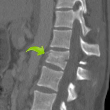 Fractura vertebral trauamtica, cirugia de columna vertebral, dr tafur, mejor neurocirujano