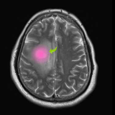 Glioma cerebral, tumor cerebral, resonancia magnetica, tratamiento quirurugico, dr tafur