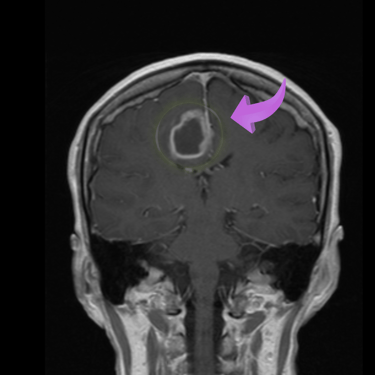 tumor cerebral maligno