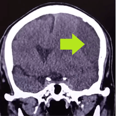 hematoma subdural cronico, cirugia cerebral, dr tafur, mejro neurocirujano