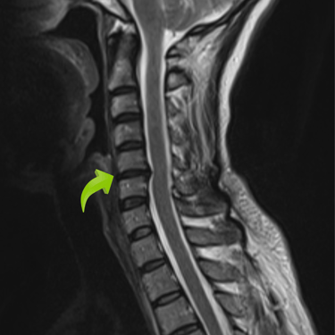 hernia cervical, columna cervical, dolor en miembros superiores, dr tafur, mejor neurocirujano