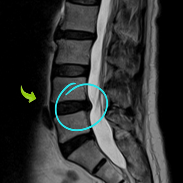 HERNIA DE DISCO LUMBAR, CIRUGIA LUMBAR - dr tafur -neuro-neurocirugia- mejor neurocirujano