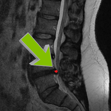 Hernia lumbar, dr tafur, cirugia de columna, mejor neurocirujano