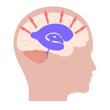 Hidrocefalia - dr david tafur - neurocirujano en lima