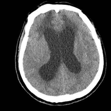 Hidrocefalia – Colocación de derivación ventriculoperitoneal (DVP) – Dr. David Tafur, neurocirujano en Lima (4)