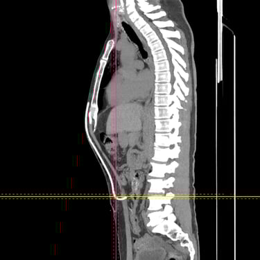 Hidrocefalia: Tratamiento mediante Derivación Ventriculoperitoneal