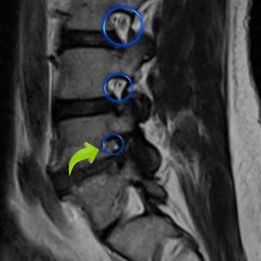 Imagen de resonancia magnetica mostrando una estenosis foraminal de columna lumbar manejada dr.Tafur
