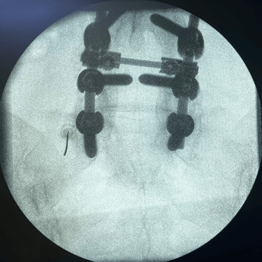 infiltracion lumbar - bloqueo selectivo- lumbalgia- procedimiento intervencionista- dr tafur -neuro-neurocirugia- mejor neuro