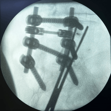 infiltracion lumbar - bloqueo selectivo- lumbalgia- procedimiento intervencionista- dr tafur -neuro-neurocirugia- mejor neuro