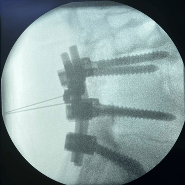infiltracion lumbar - bloqueo selectivo- lumbalgia- procedimiento intervencionista- dr tafur -neuro-neurocirugia- mejor neuro