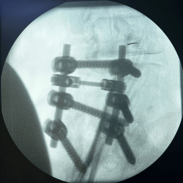 infiltracion lumbar - bloqueo selectivo- lumbalgia- procedimiento intervencionista- dr tafur -neuro-neurocirugia- mejor neuro