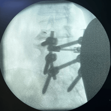 infiltracion lumbar - bloqueo selectivo- lumbalgia- procedimiento intervencionista- dr tafur -neuro-neurocirugia- mejor neuro