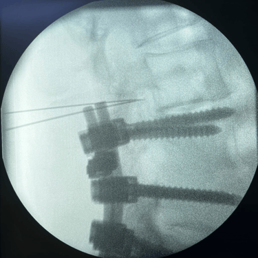 infiltracion lumbar - bloqueo selectivo- lumbalgia- procedimiento intervencionista- dr tafur -neuro-neurocirugia- mejor neuro