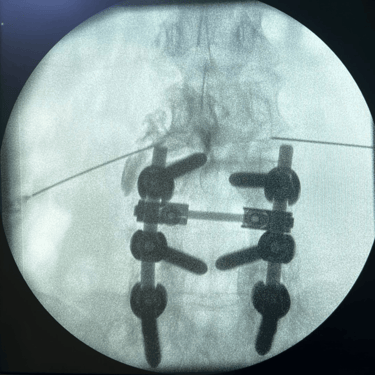 infiltracion lumbar - bloqueo selectivo- lumbalgia- procedimiento intervencionista- dr tafur -neuro-neurocirugia- mejor neuro