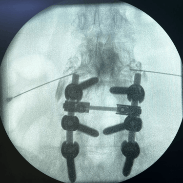 infiltracion lumbar - bloqueo selectivo- lumbalgia- procedimiento intervencionista- dr tafur -neuro-neurocirugia- mejor neuro