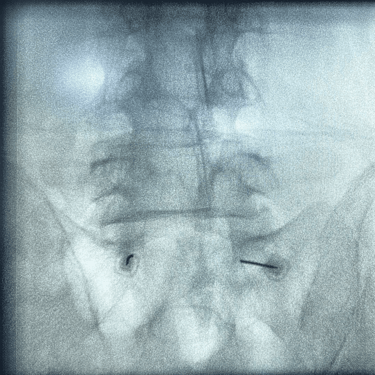 infiltracion lumbar - bloqueo selectivo- lumbalgia- procedimiento intervencionista- dr tafur -neuro-neurocirugia- mejor neuro