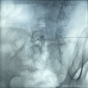 infiltracion lumbar - bloqueo selectivo- lumbalgia- procedimiento intervencionista- dr tafur -neuro-neurocirugia- mejor neuro