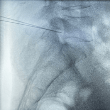 infiltracion lumbar - bloqueo selectivo- lumbalgia- procedimiento intervencionista- dr tafur -neuro-neurocirugia- mejor neuro