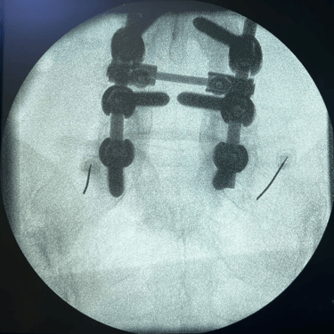 infiltracion lumbar - bloqueo selectivo- lumbalgia- procedimiento intervencionista- dr tafur -neuro-neurocirugia- mejor neuro