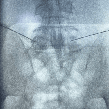infiltracion lumbar - bloqueo selectivo- lumbalgia- procedimiento intervencionista- dr tafur -neuro-neurocirugia- mejor neuro