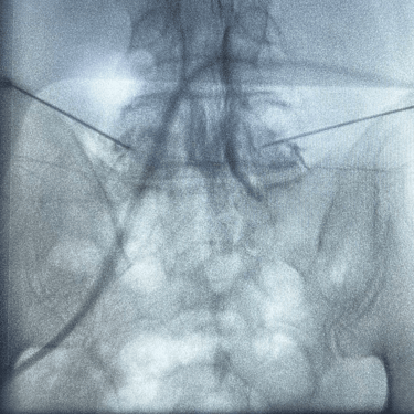 infiltracion lumbar - bloqueo selectivo- lumbalgia- procedimiento intervencionista- dr tafur -neuro-neurocirugia- mejor neuro