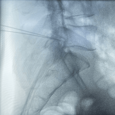 infiltracion lumbar - bloqueo selectivo- lumbalgia- procedimiento intervencionista- dr tafur -neuro-neurocirugia- mejor neuro