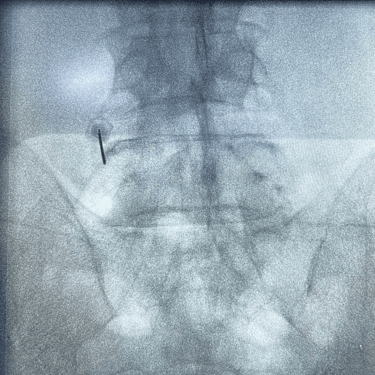 infiltracion lumbar - bloqueo selectivo- lumbalgia- procedimiento intervencionista- dr tafur -neuro-neurocirugia- mejor neuro