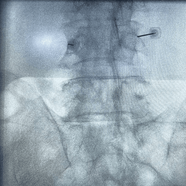 infiltracion lumbar - bloqueo selectivo- lumbalgia- procedimiento intervencionista- dr tafur -neuro-neurocirugia- mejor neuro