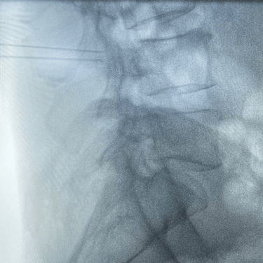 infiltracion lumbar - bloqueo selectivo- lumbalgia- procedimiento intervencionista- dr tafur -neuro-neurocirugia- mejor neuro