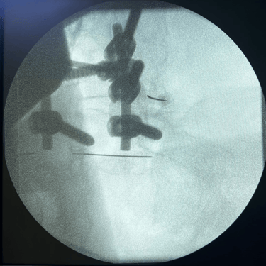 infiltracion lumbar - bloqueo selectivo- lumbalgia- procedimiento intervencionista- dr tafur -neuro-neurocirugia- mejor neuro